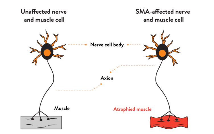 How are nerves a!ected in SMA?